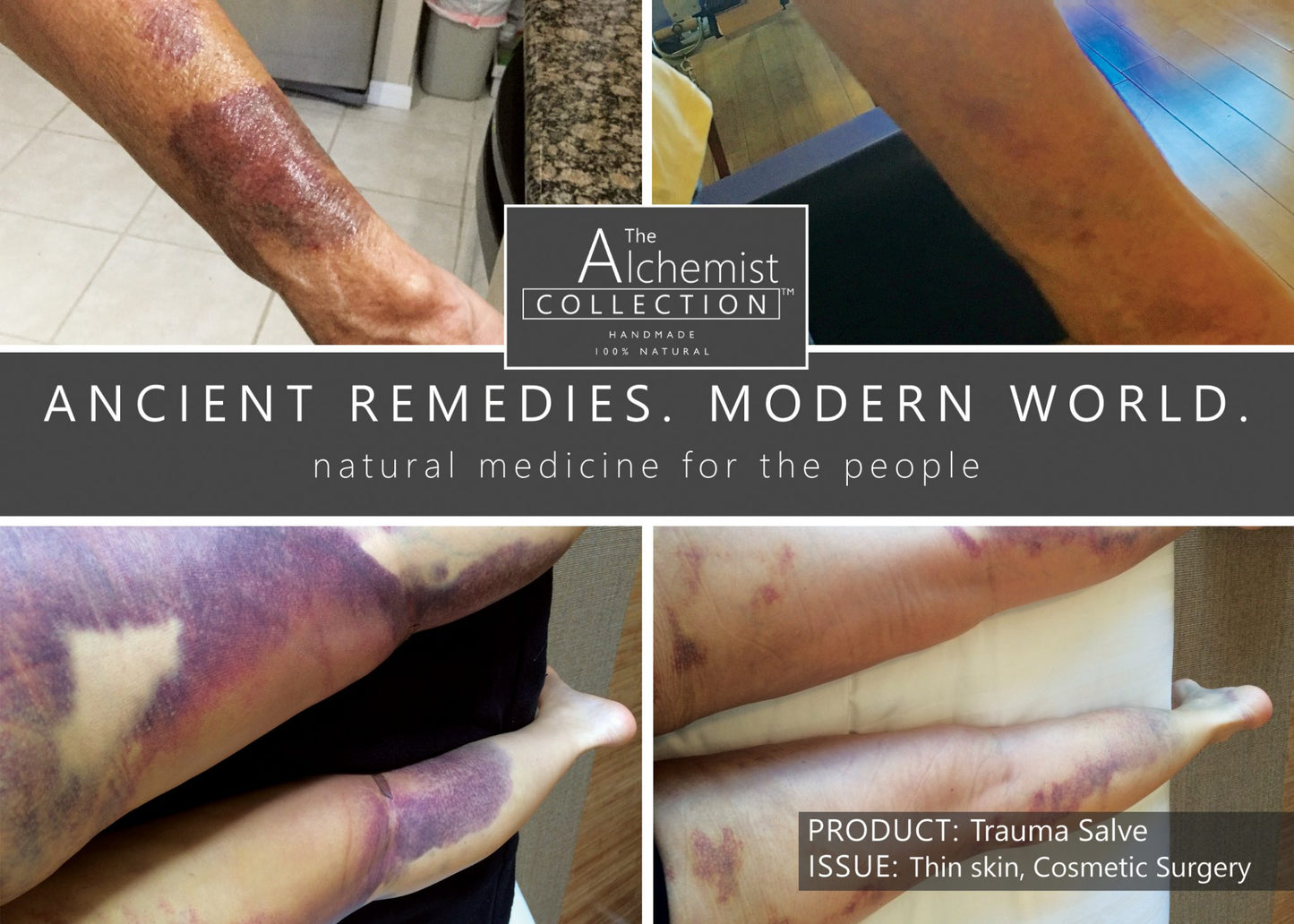PAIN/FIRST AID: Trauma Salve for pain, swelling and bruising due to acute injury and blunt force trauma