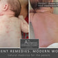 ITCH & RASH: Viraease pain, itch & rash rash relief due to HSV1, HSV2, Shingles, Chickenpox