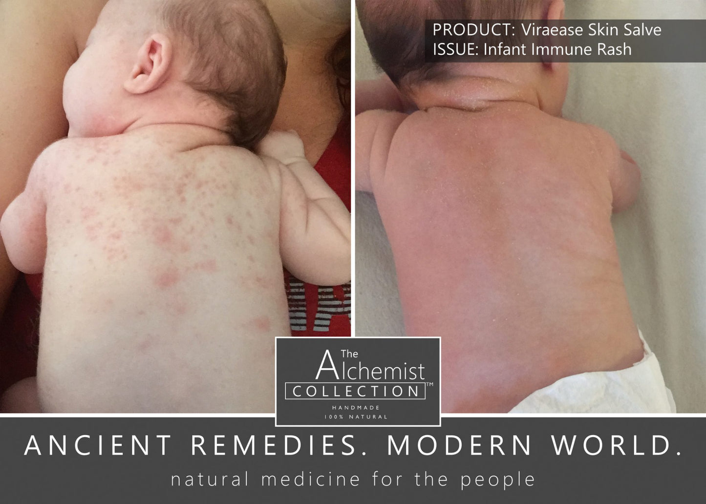 ITCH & RASH: Viraease pain, itch & rash rash relief due to HSV1, HSV2, Shingles, Chickenpox